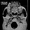 INTESTINAL DISGORGE - Everlasting Fractal Nightmare